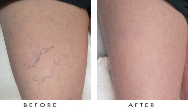 What Is The Best Way To Treat Spider Veins Dr Shel Wellness