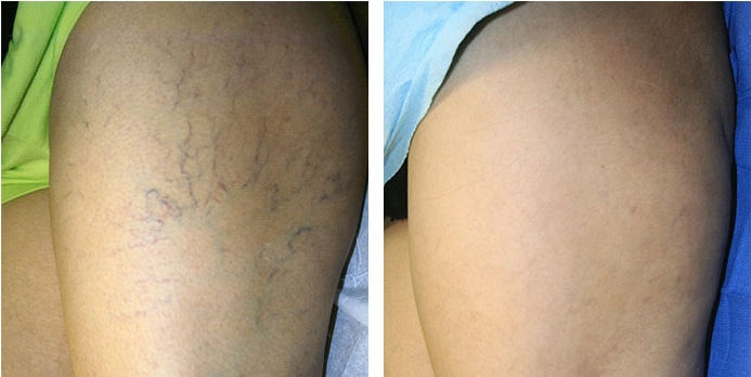 Laser Spider Vein Removal