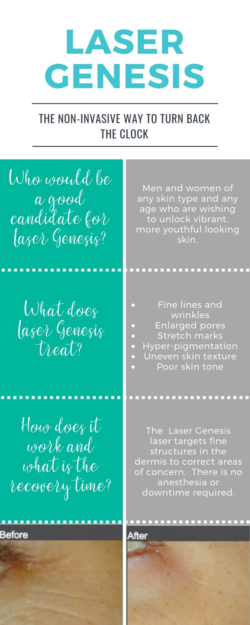 The In's and Out's of Laser Genesis Dr. Shel Wellness & Aesthetic Center