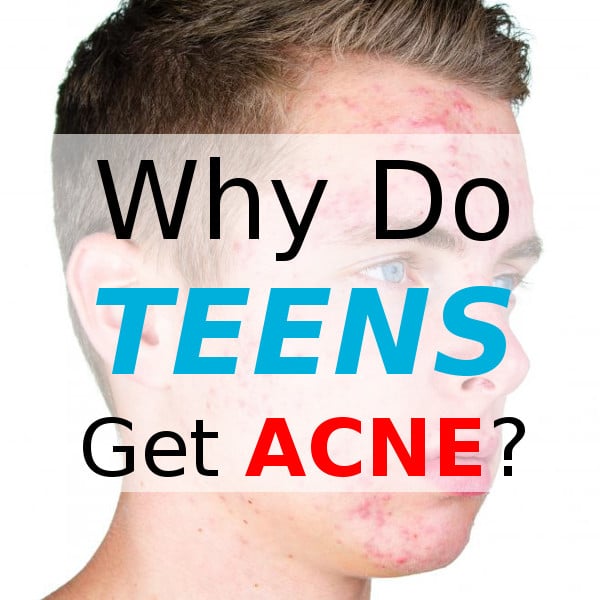 why-do-teens-get-acne