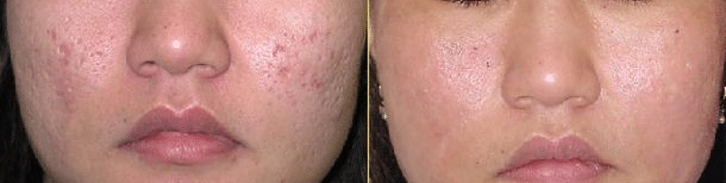 PRP Microneedling Before and After