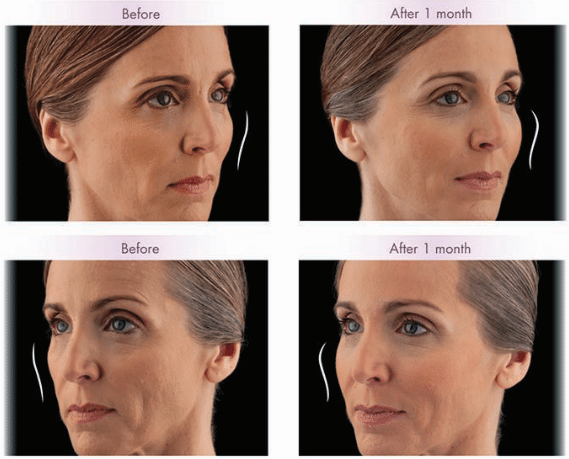 Voluma Before and After