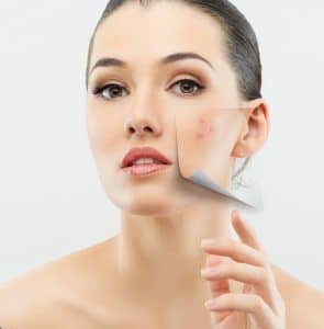 acne treatment