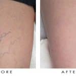 Laser Spider Vein Removal Before and After