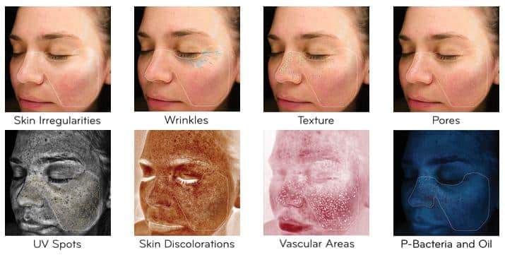 Visia Skin Analysis