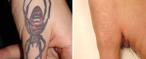 Laser Tattoo Removal 1