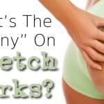 What's the Skinny on Stretch Marks?