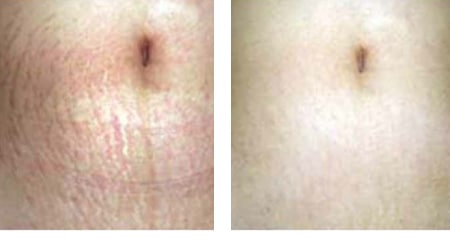 Micro-Needling with PRP