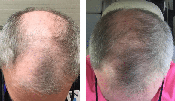 PRP for Hair Restoration Houston TX | Dr. Shel Wellness Spa