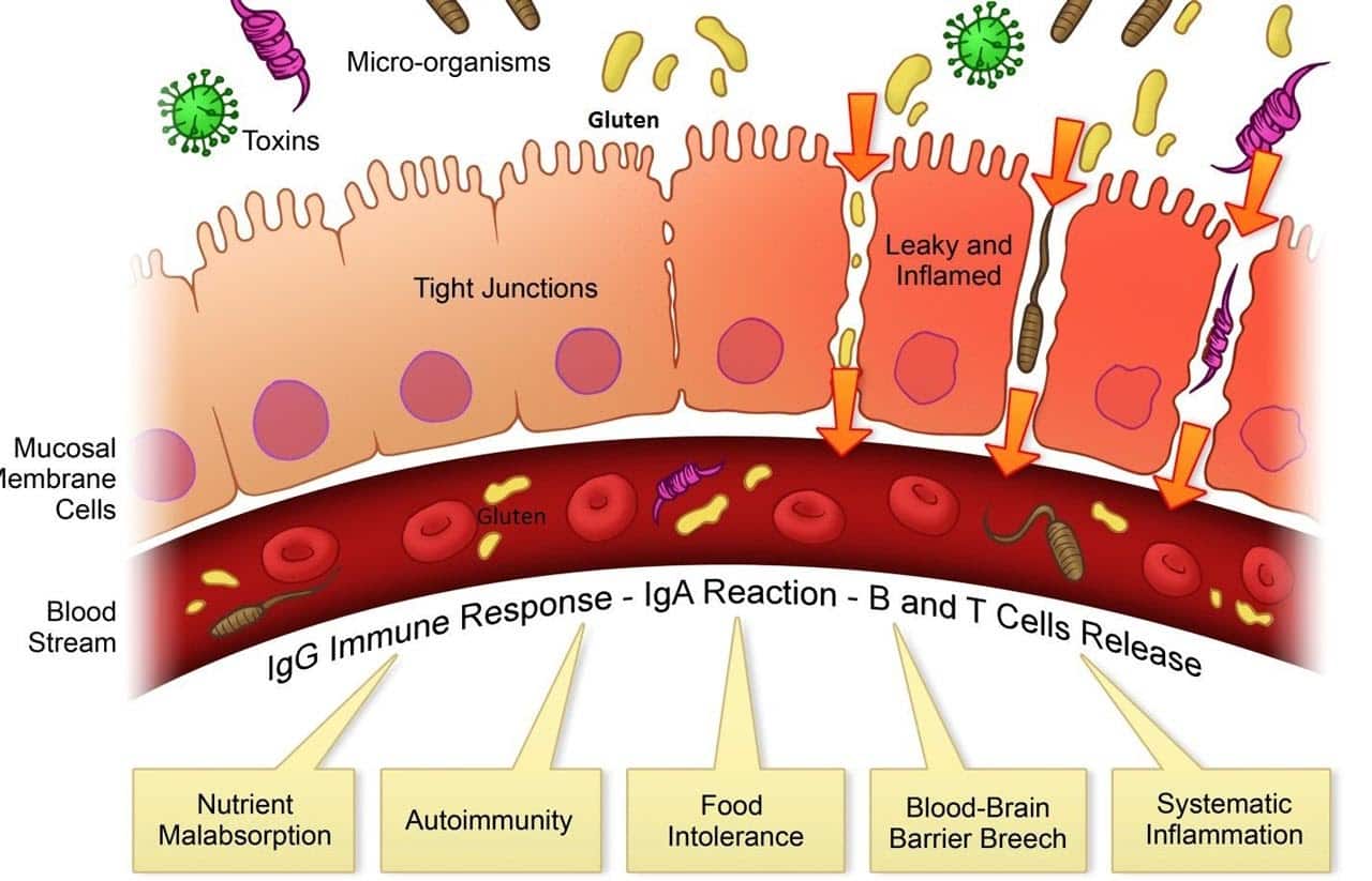 Leaky Gut