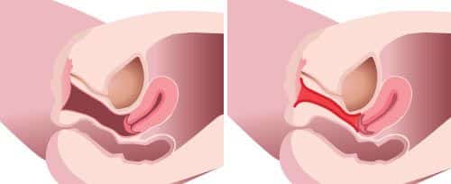 IntimaLase Laser Vaginal Rejuvenation